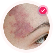 Светлые родимые пятна